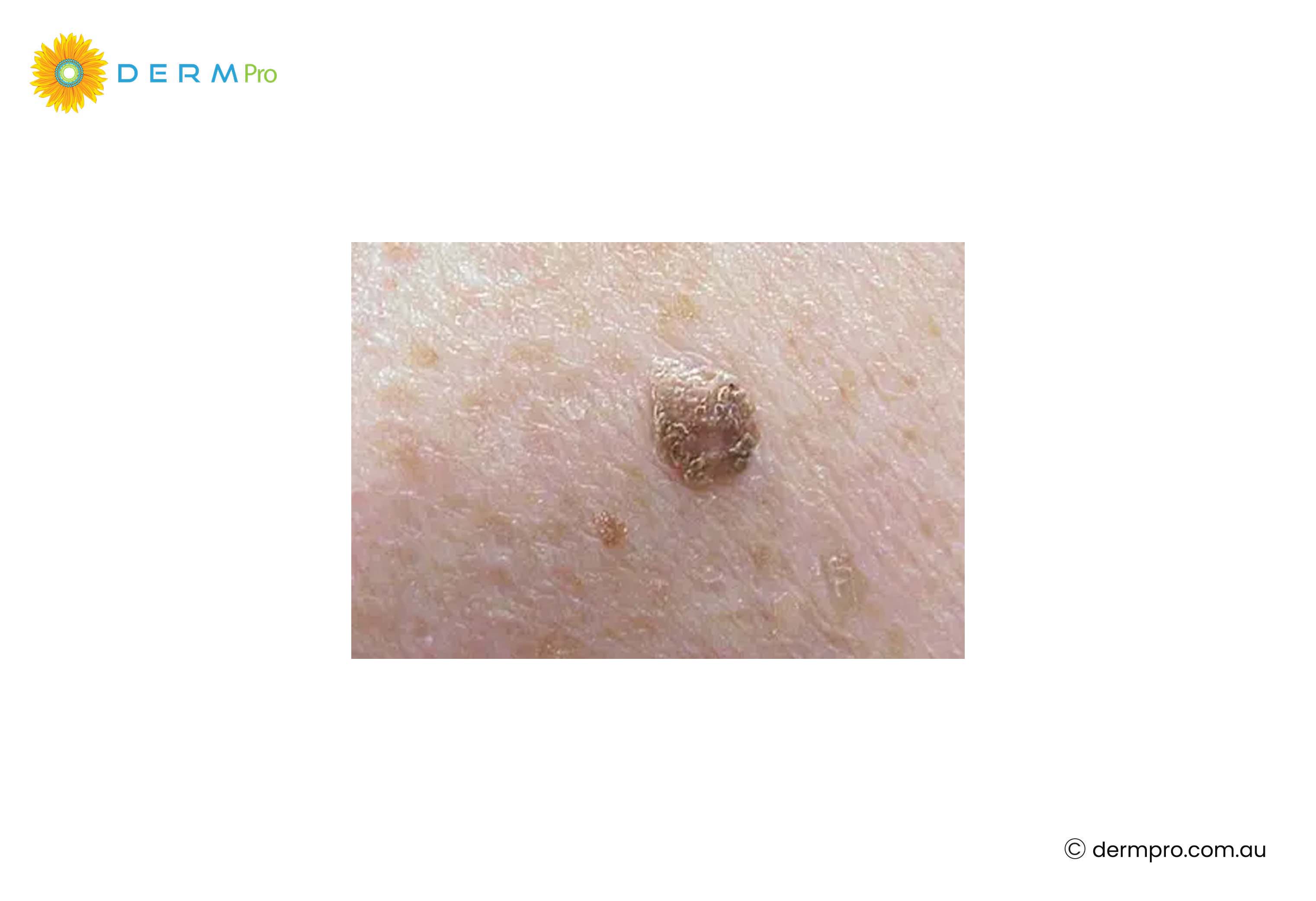 Seborrheic Keratoses images